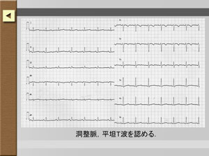 症例の心電図が見られます。